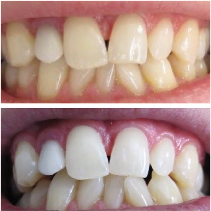 Teeth cleaning before and after